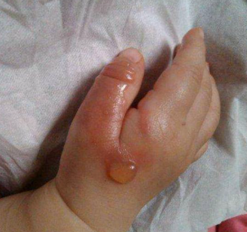 三岁孩子被100度开水烫着，妈妈用1小时4步处理，医生：做得好