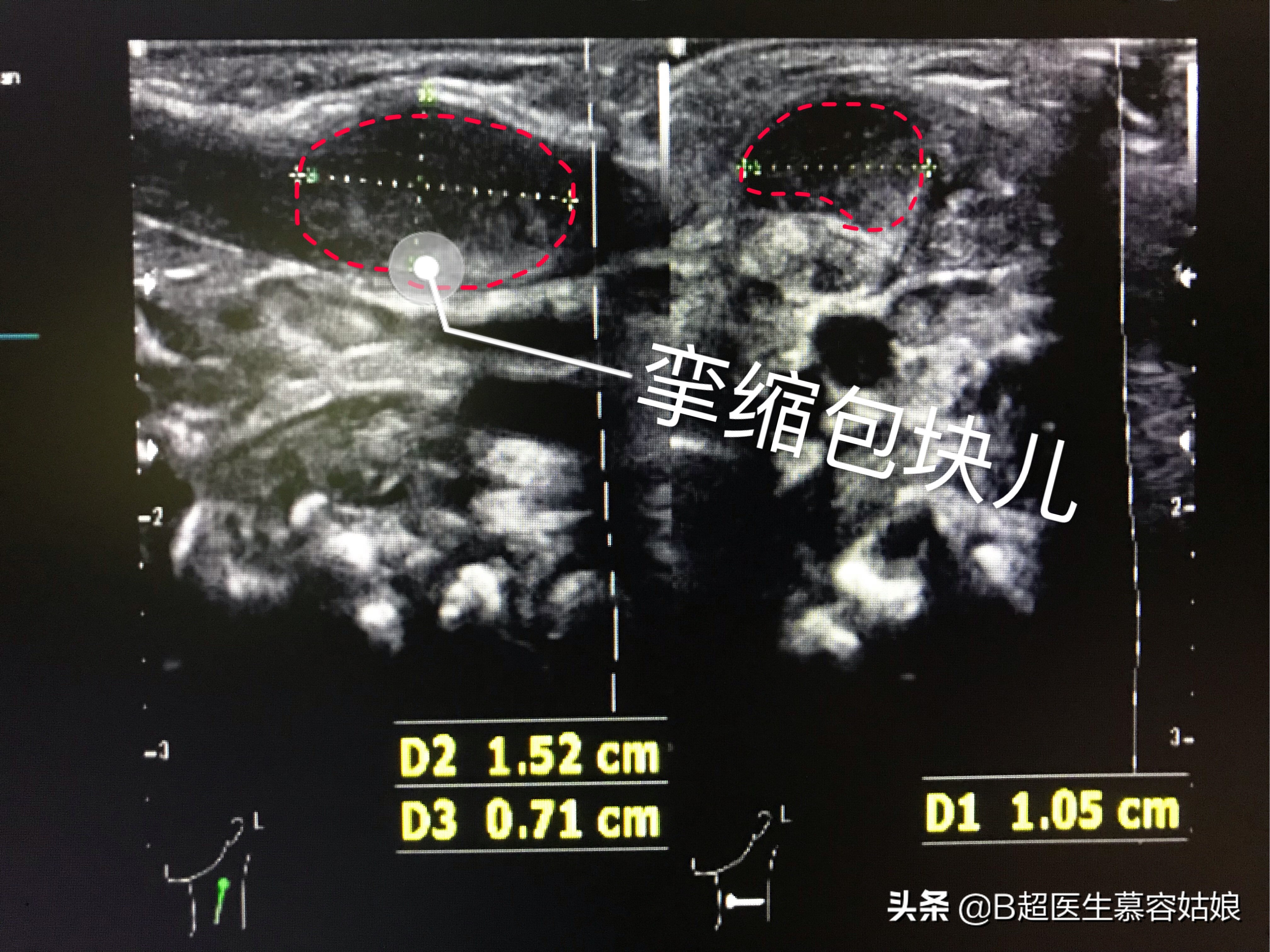 宝宝总是歪头，面向一侧，俗称“歪脖”，听说这叫斜颈，怎么办？