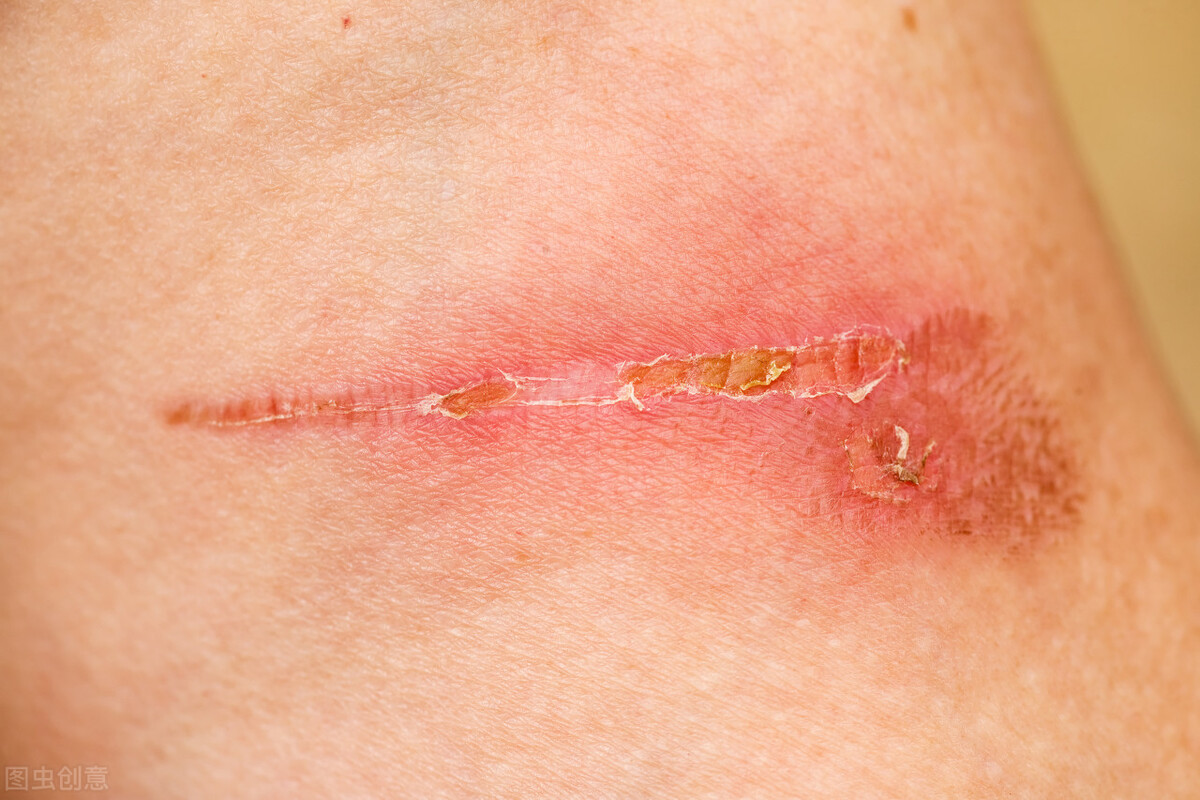 木瓜膏的作用与功效，治烫伤及蚊虫叮咬吗？