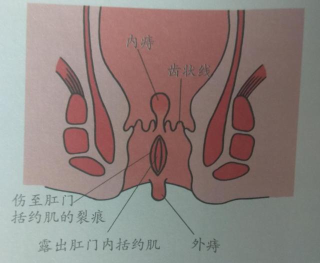 痔疮有3型4期，快来对照下，你是哪一型，哪一期？