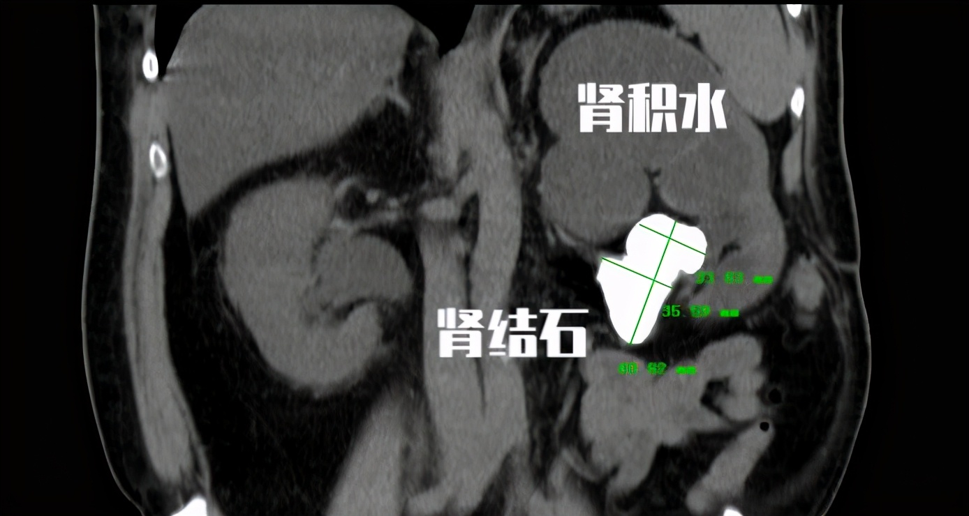 平时检查肾功能反应什么？指标说明什么？一篇文章带你读懂肾功能