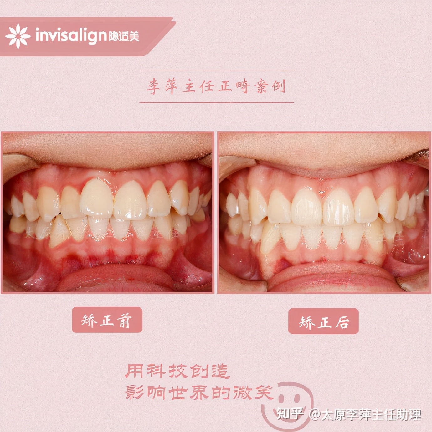 太原牙齿矫正：隐形牙套效果好不好？看这些病例你就知道了
