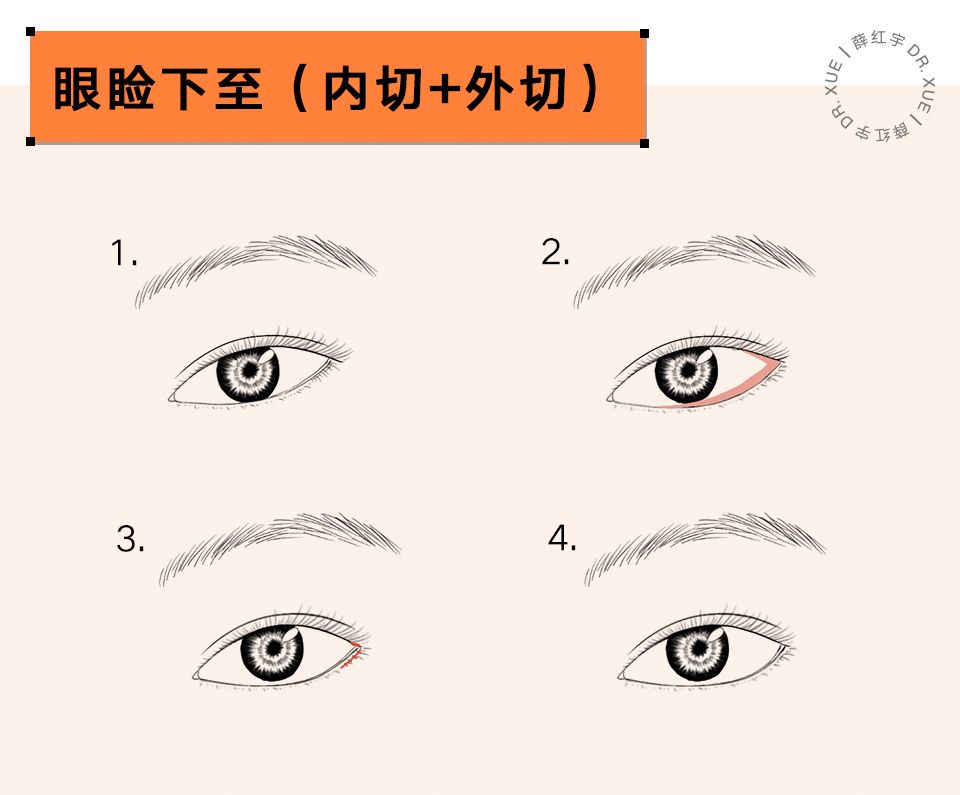 要不要开外眼角？要不要做眼睑下至？