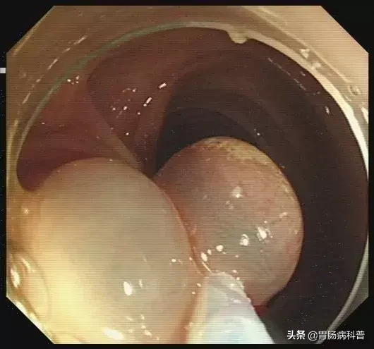 医生是怎样切掉肠息肉的?