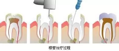 补牙花了2W多亏吗？越早治疗越省钱！#雅悦齿科#