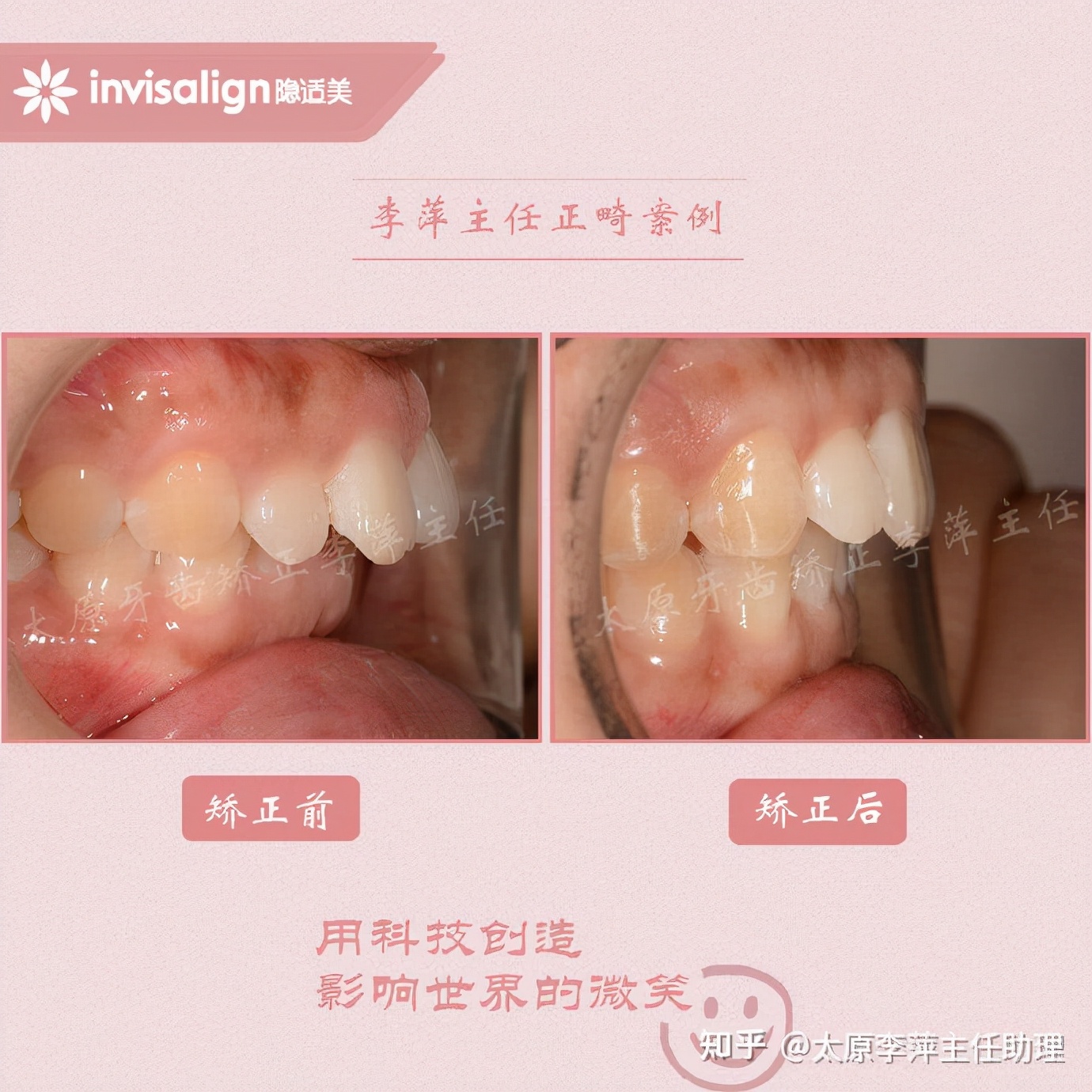 太原牙齿矫正：隐形牙套效果好不好？看这些病例你就知道了