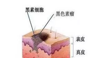 如何分辨黑痣的「好坏」？恶性黑色素瘤好发于哪些部位？