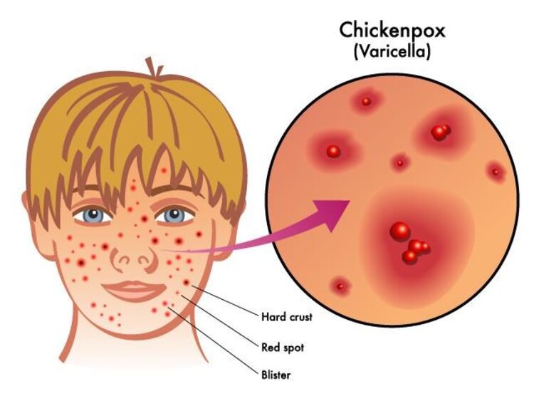 长痘的位置及原因图片，痘痘长在皮肤的哪一层？