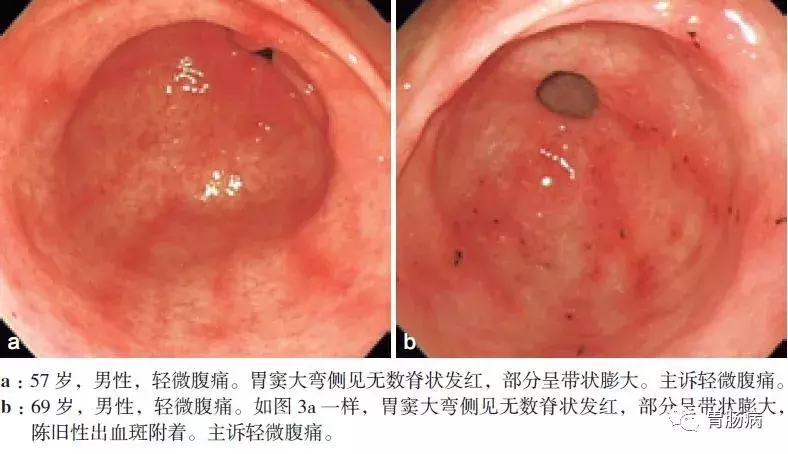 慢性浅表性（非萎缩性）胃炎