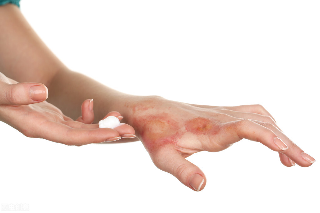 涂牙膏、抹猪油、敷蛋清、铺面粉？你真的知道怎样处理烧烫伤吗？