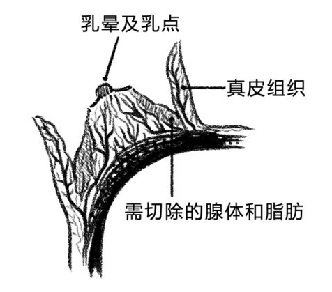 在国内,应用较多的巨乳缩小术术式主要为下蒂瓣法,垂直双蒂瓣法和双环