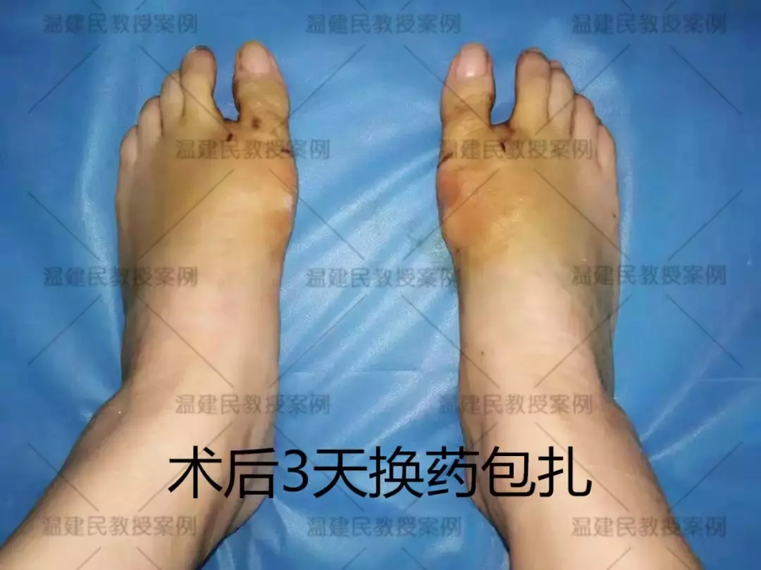 这位患者拇外翻拖了20年,畸形疼痛越来越重,10分钟手术就矫正
