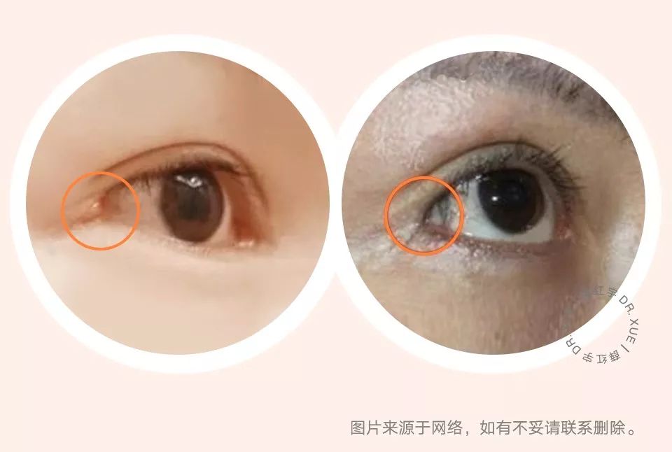 要不要开外眼角？要不要做眼睑下至？