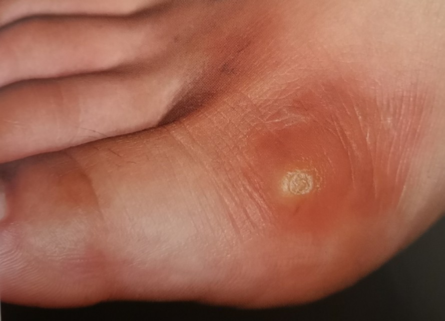 那,鸡眼到底是什么?