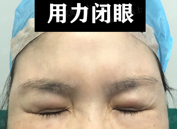 不合格填充脂肪带来的反效果：变肿眼泡、眼皮鼓包、凹凸不平