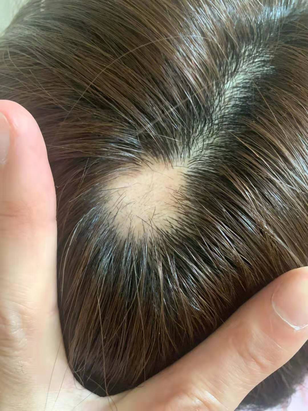 头皮明显空一块,因过度焦虑没有毛囊