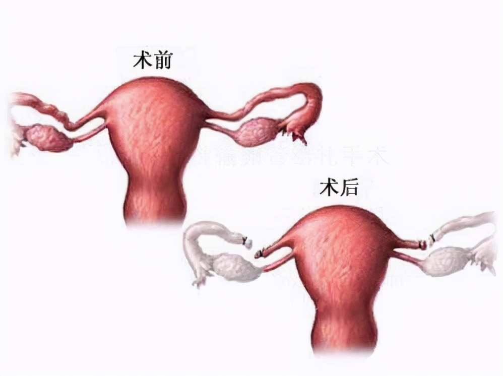 男性结扎vs女性结扎，到底该谁来做？先不要争，了解清楚再说