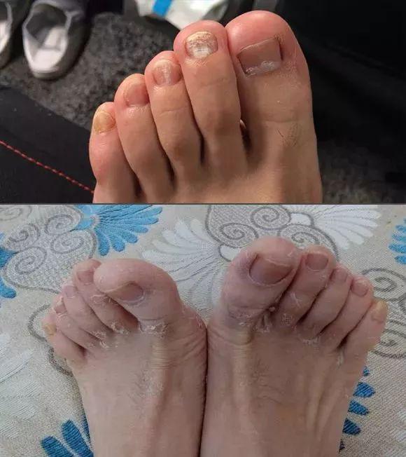 原来脚臭最怕的是