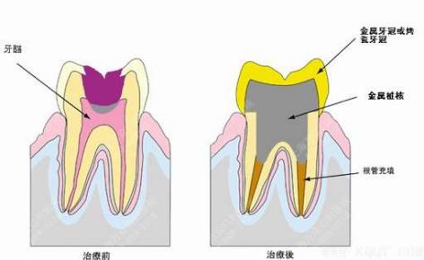 牙齿缺失后装固定牙桥，为什么牙反而更疼了？专业牙医告诉你原因