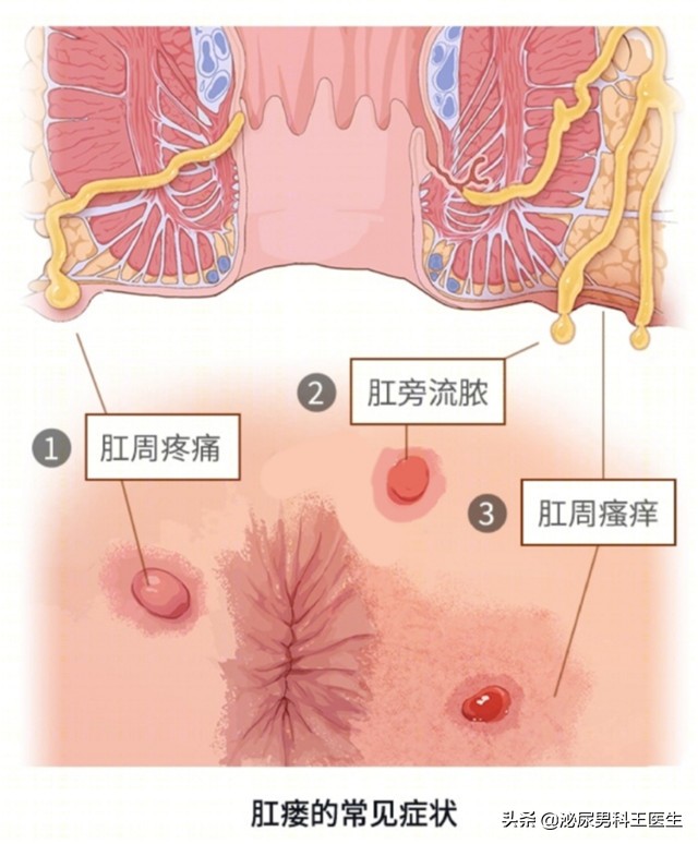 肛瘘患者：“不想治了，我真的太痛了！”肛瘘手术到底有多痛？