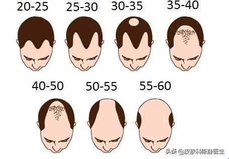 雄激素性脱发，除了植发，你还有很多选择