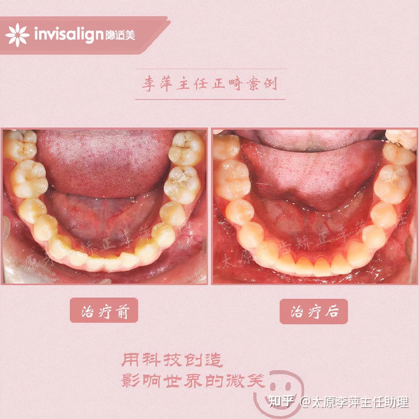 太原牙齿矫正：隐形牙套效果好不好？看这些病例你就知道了