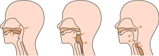 中秋团圆聚会，饭后出现反酸烧心要注意，当心胃食管反流找到你
