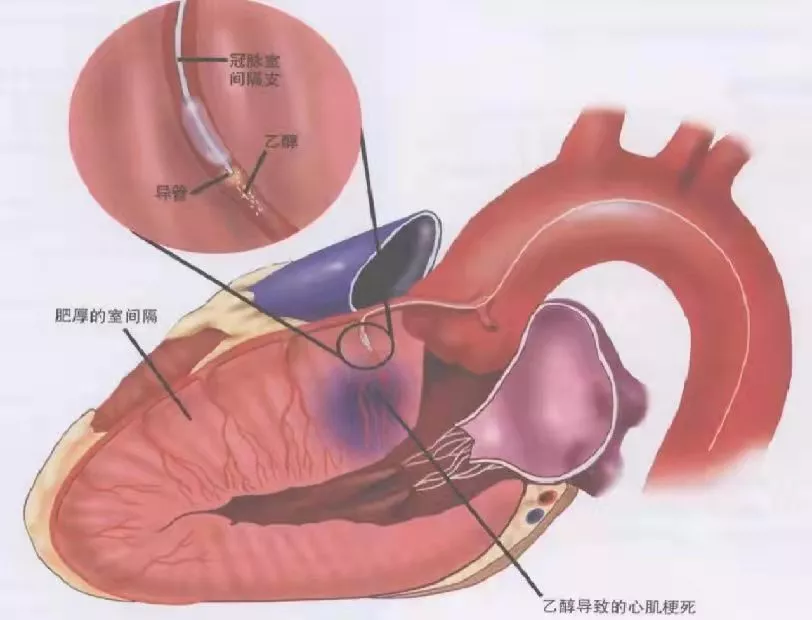 德州市人民醫(yī)院成功為肥厚性心肌病患者實行室間隔化學消融術