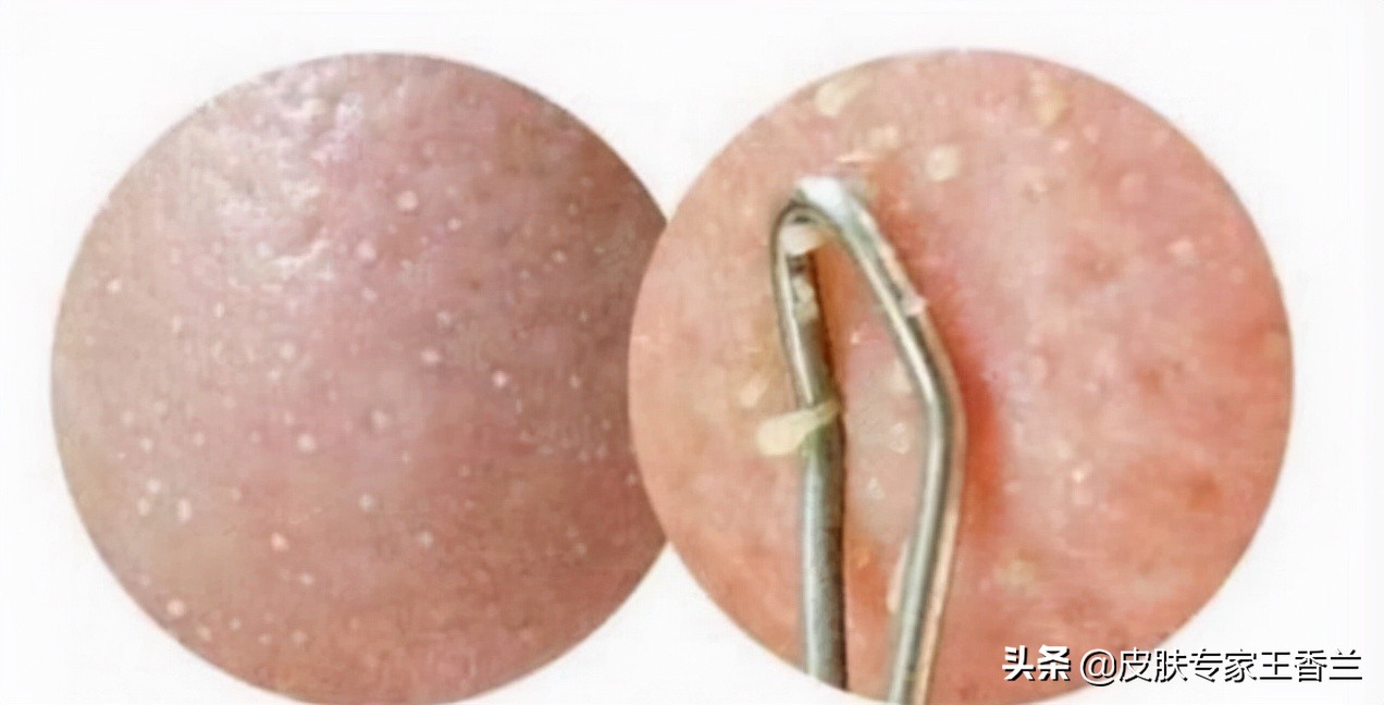 脸上挤出来“白色条状物”是什么东西？有办法去除吗