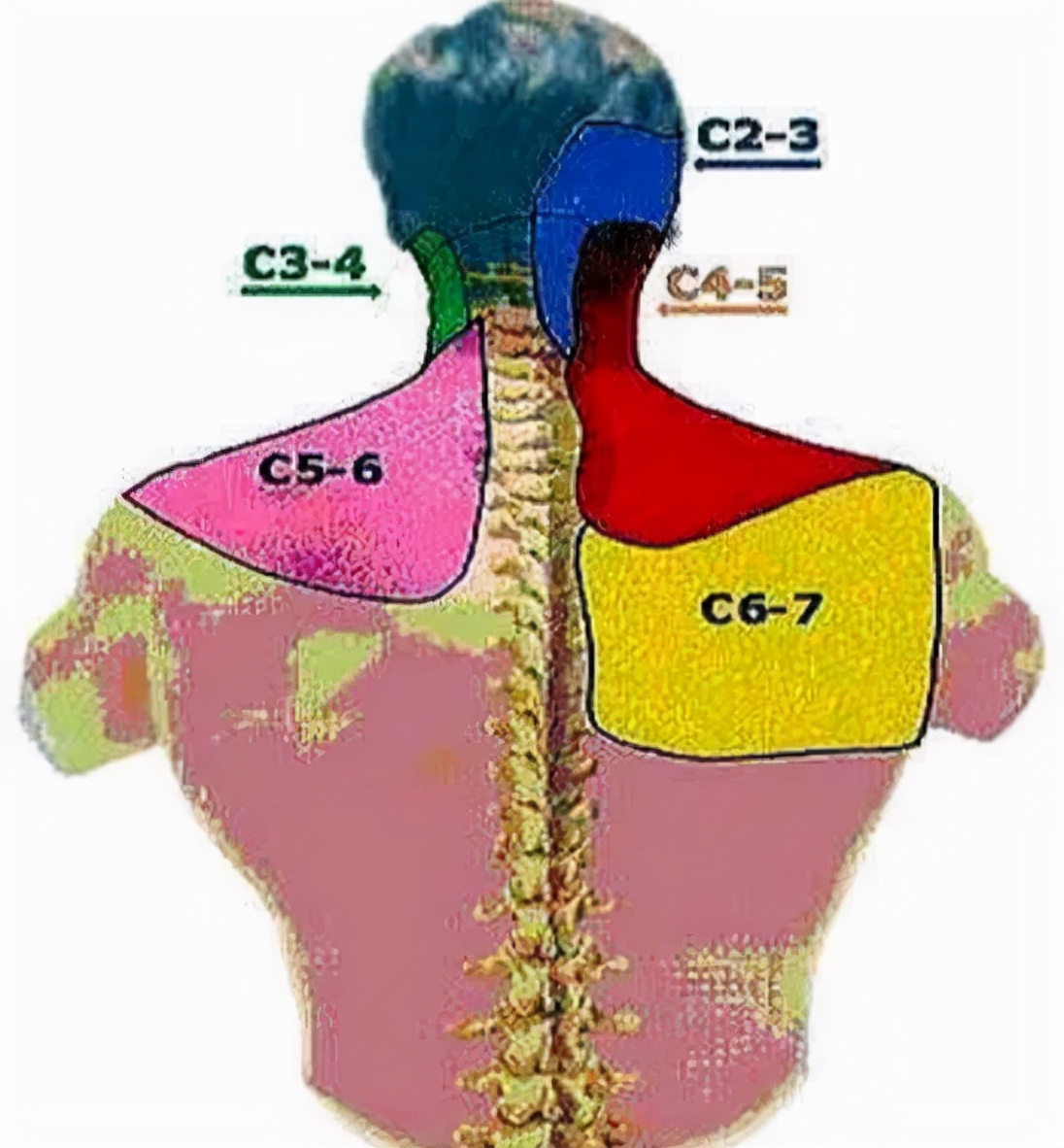 后背痛位置图详解图片