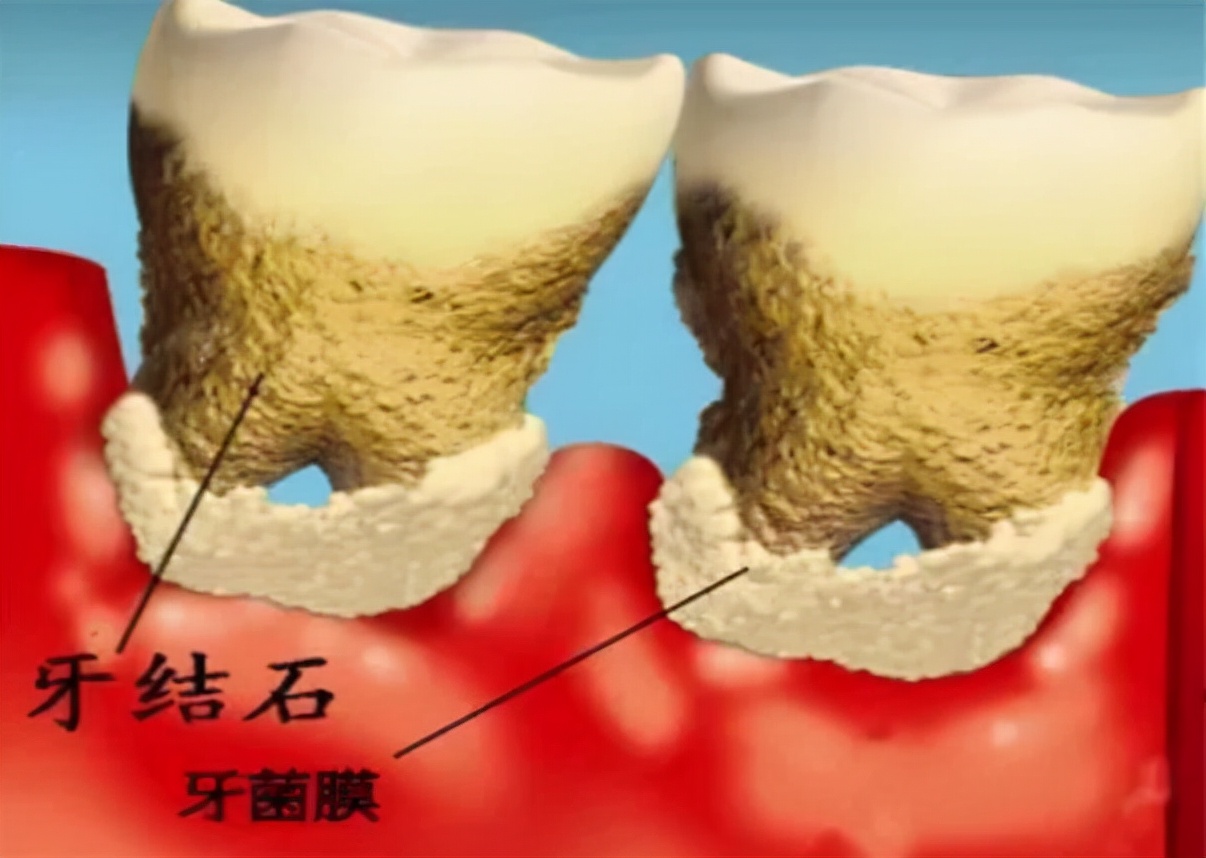 “牙结石”可以自己抠掉吗？教你一招，牙缝里的脏东西或能轻松掉