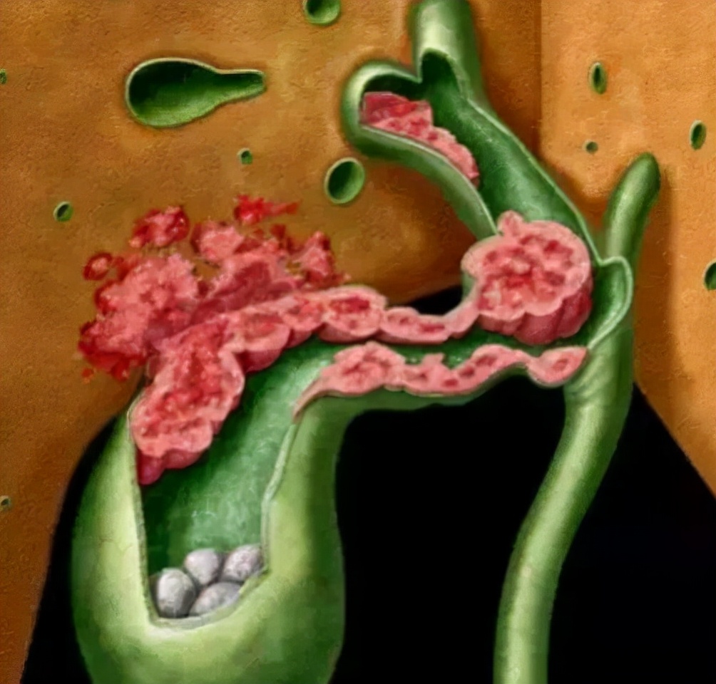 咱们今天来聊聊一种不常见的结石：肝内胆管结石