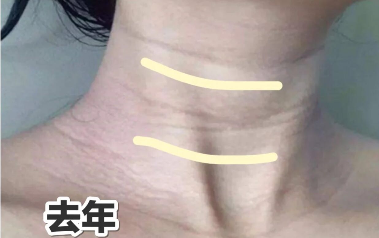 想要拥有颈，光靠做操没用，去除颈纹才是关键，不然显老10岁