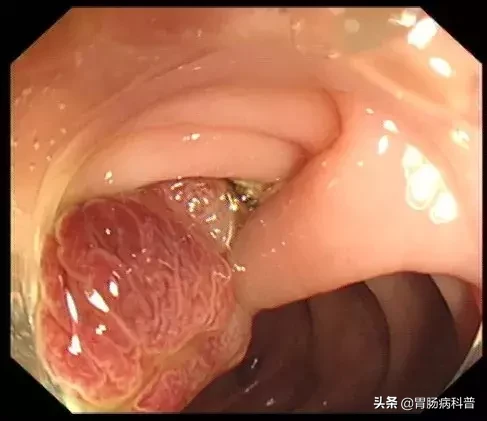 医生是怎样切掉肠息肉的?