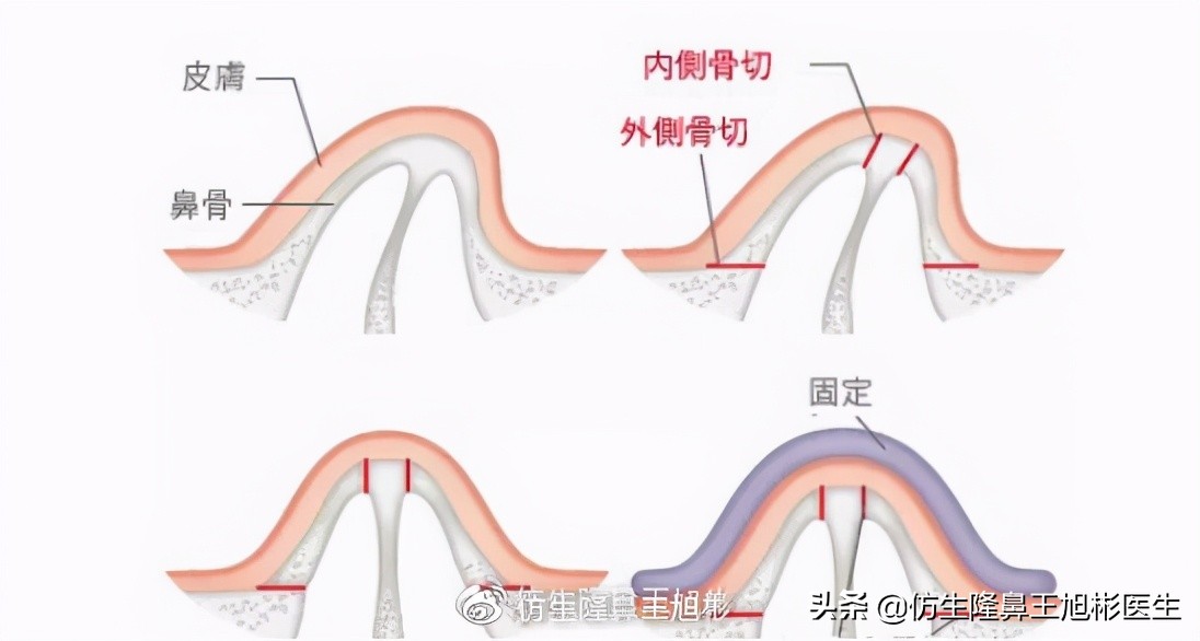 歪鼻矫正怎么做？术后如何护理？会不会反弹？