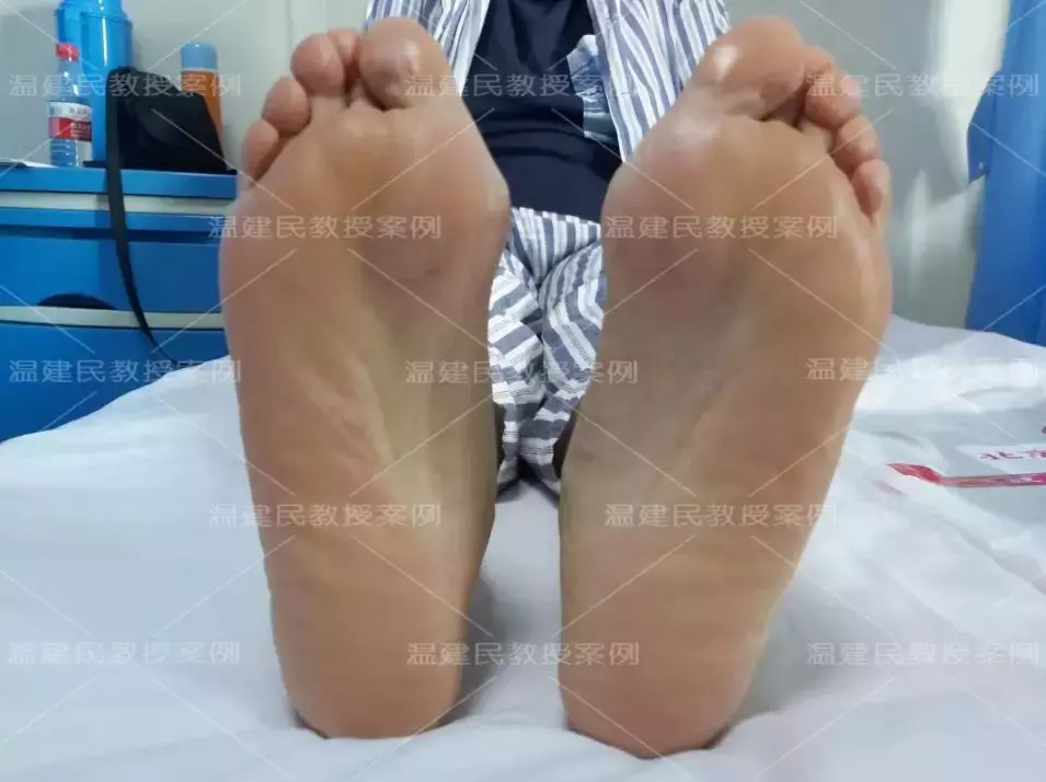这位患者拇外翻拖了20年,畸形疼痛越来越重,10分钟手术就矫正