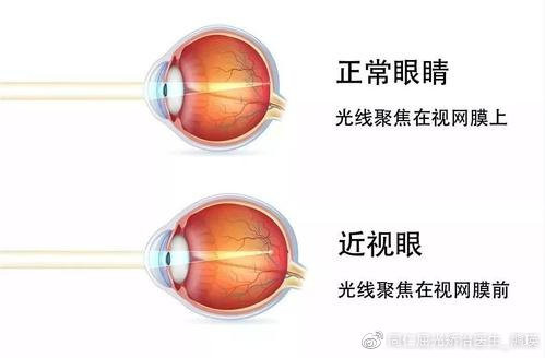 如何通过自然方法有效恢复视力