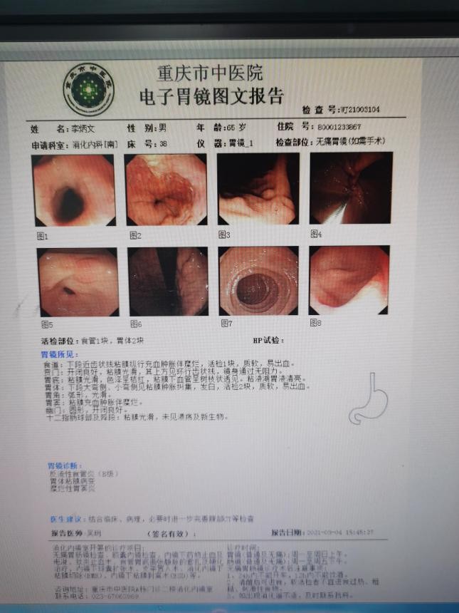糜烂性胃炎，现在一吃东西就胃胀，该怎么办？