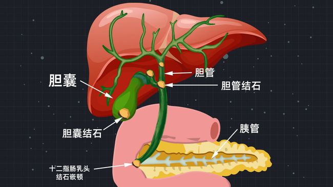 胆结石严重吗图片