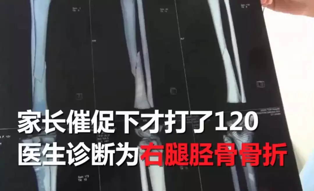 10岁女孩玩网红蹦床致右腿骨折，律师：安全协议为无效合同