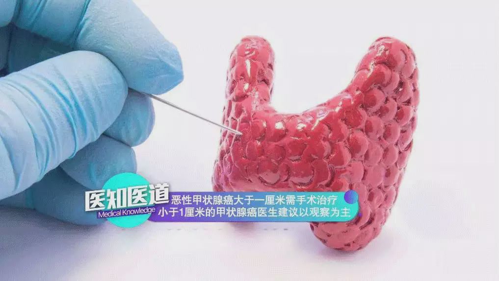 桥本氏甲状腺炎，能治愈吗？会不会癌变？你想知道的都在这