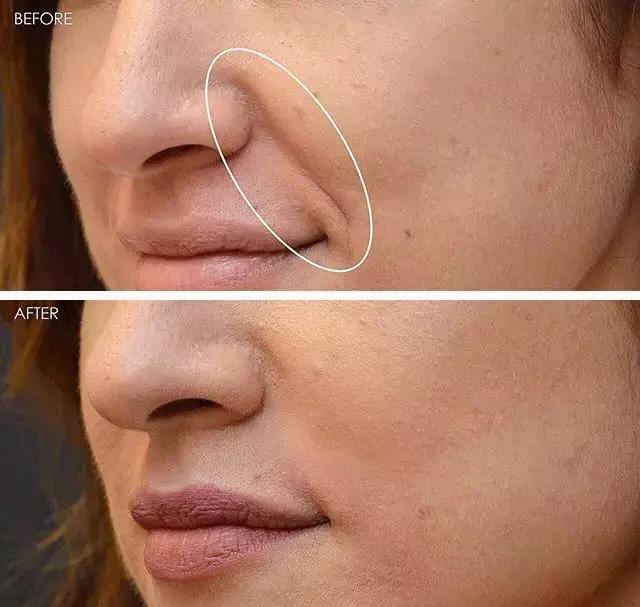 鼻子两侧八字纹很深怎么消除(让.女人夜夜疯狂的神器)