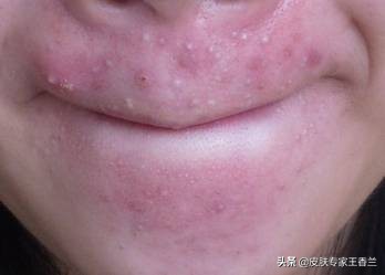 脸上挤出来“白色条状物”是什么东西？有办法去除吗