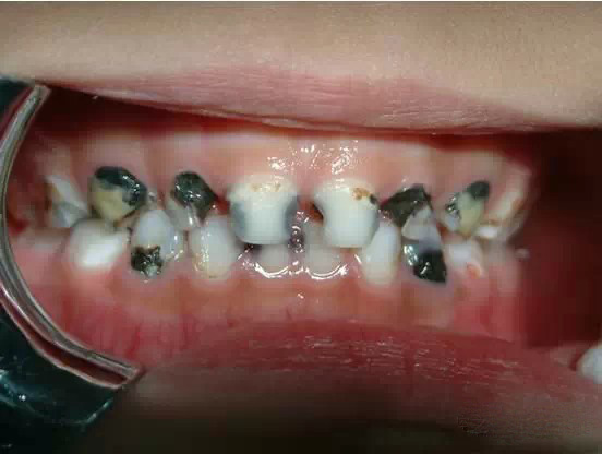 牙齿长虫子图片