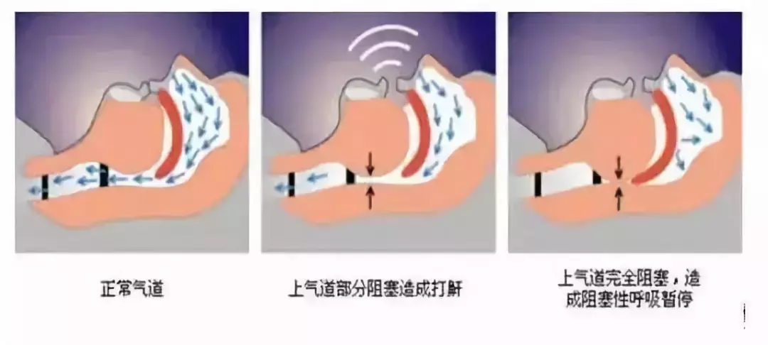 宝宝打呼噜别大意，它可能是疾病的征兆