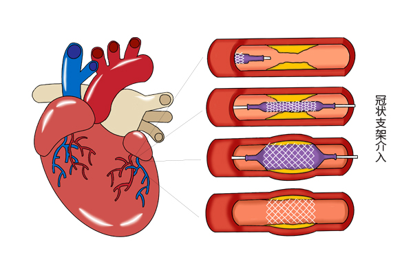 心脏搭桥和心脏支架一样吗？冠心病患者选择哪个好？听听医生分析