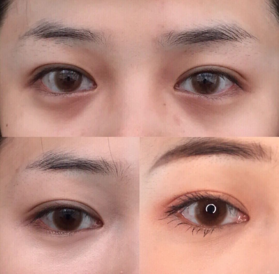 要不要手术“祛眼袋”?医生讲解手术后遗症,网友:不敢去了