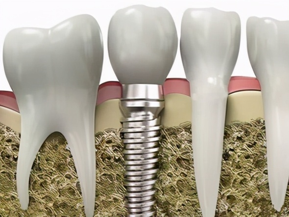 老年人牙齿缺失之后,镶什么样的假牙好?