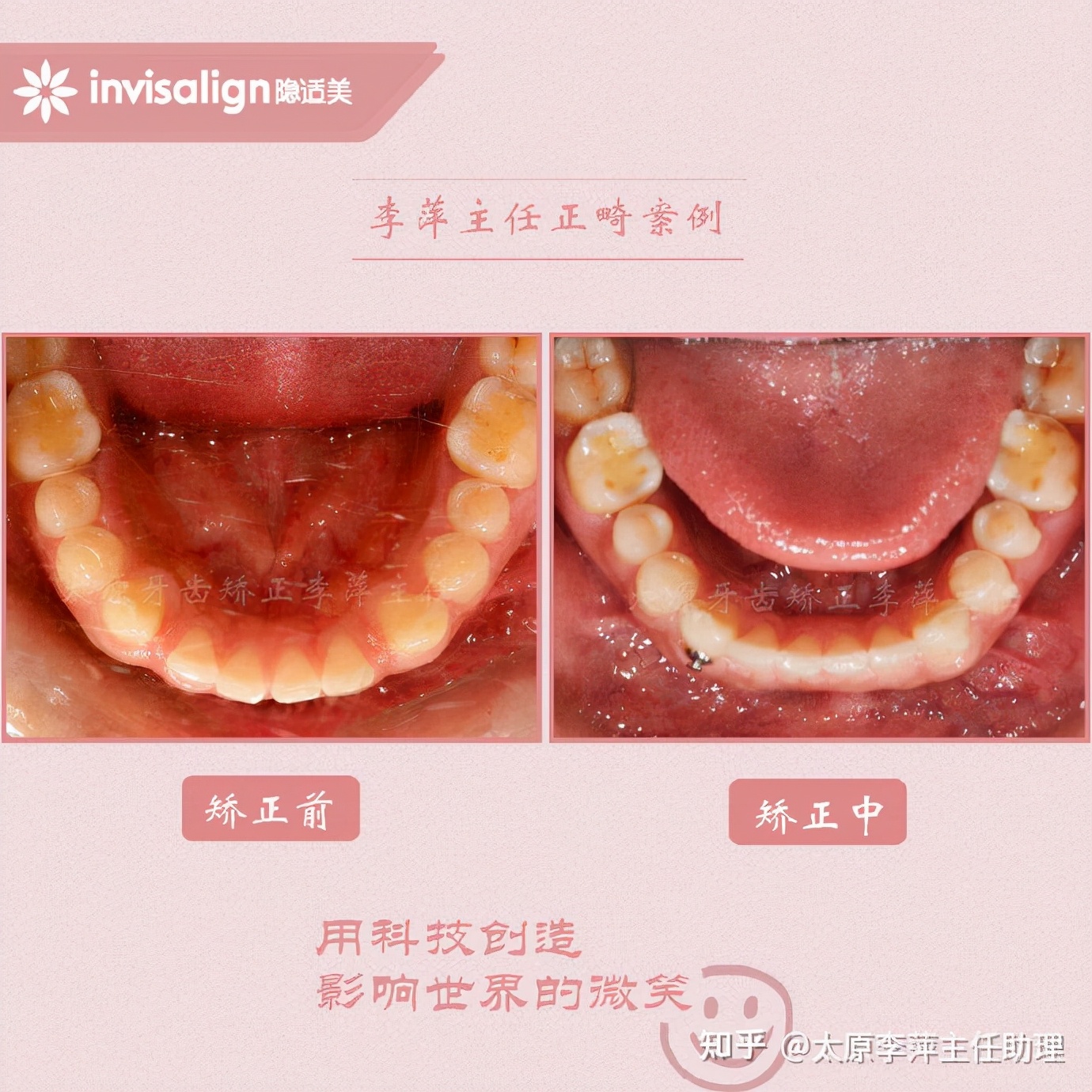 太原牙齿矫正：隐形牙套效果好不好？看这些病例你就知道了