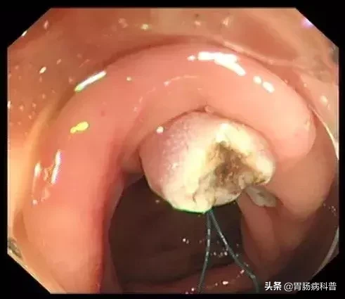 医生是怎样切掉肠息肉的?